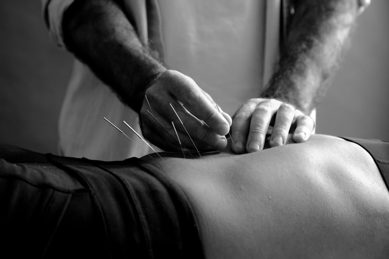 Acupuncture Therapy
